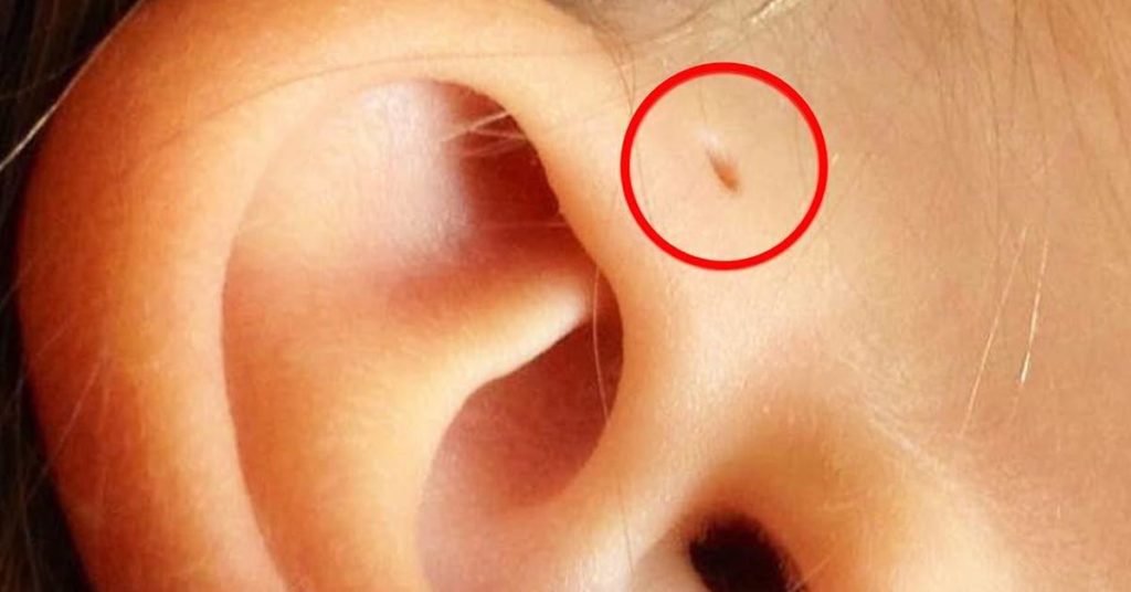 image qui illustre un trou d’oreille